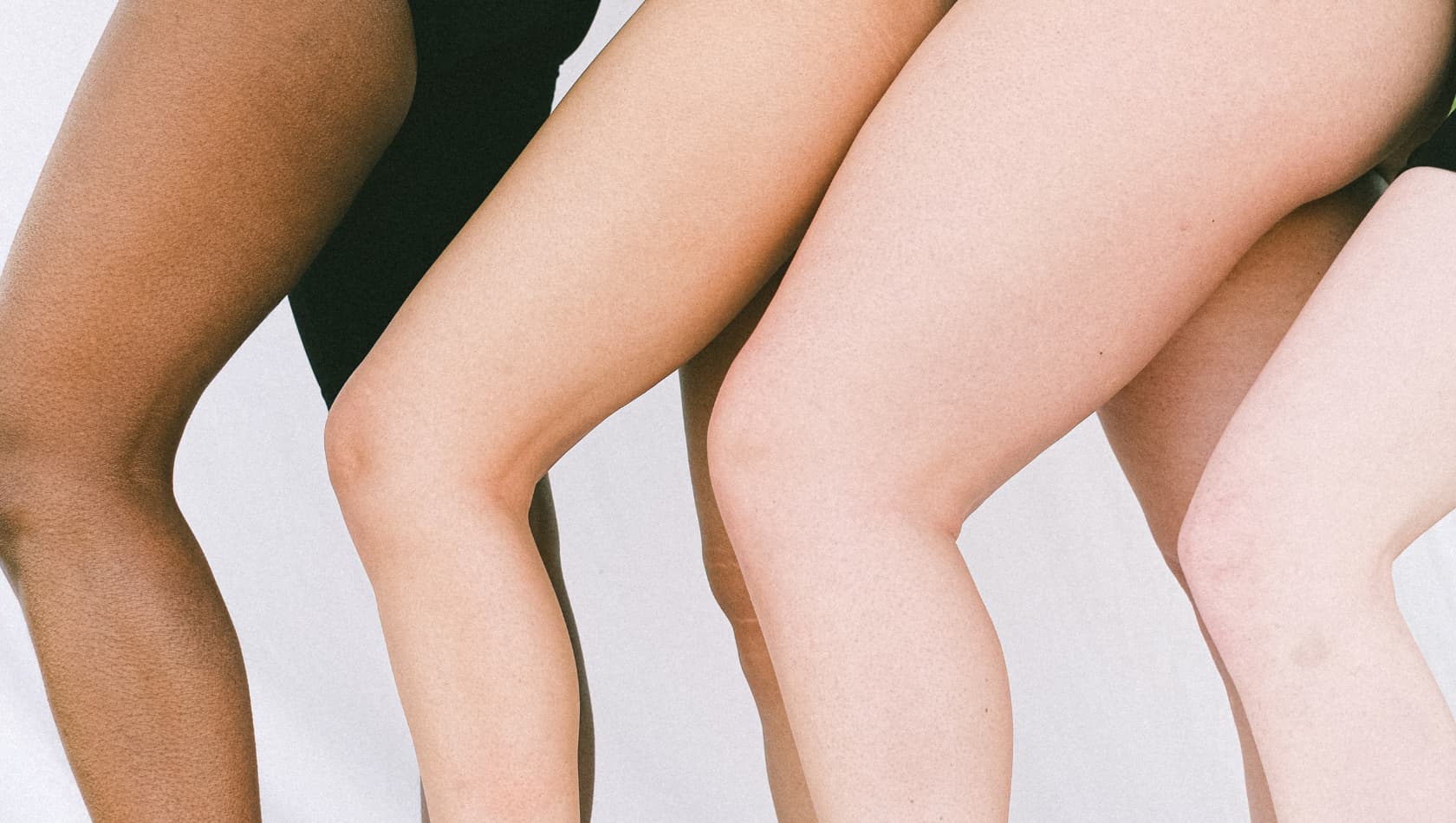 Lipedema entra no radar da estética avançada e desafia profissionais a olharem além da balança